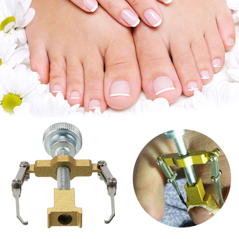 INGROWN NAIL CORRECTOR